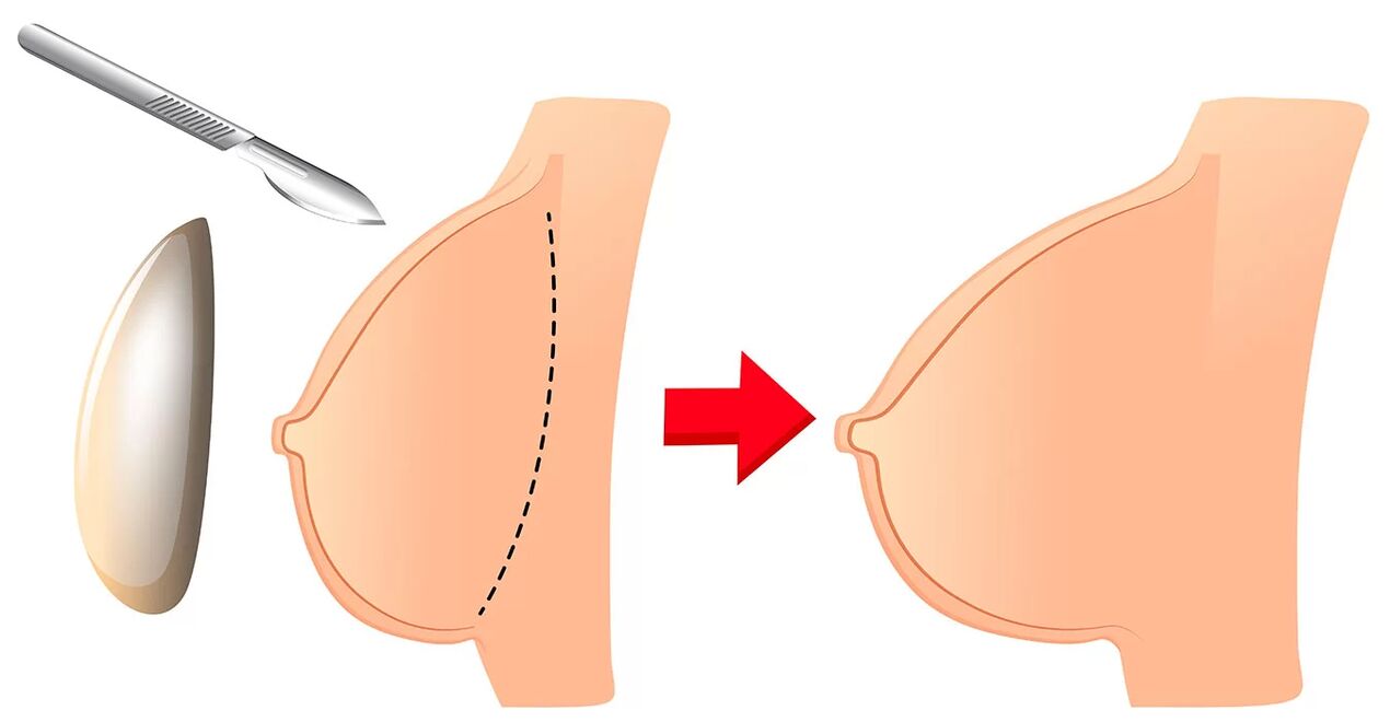Brustvergrößerung mit einer Prothese